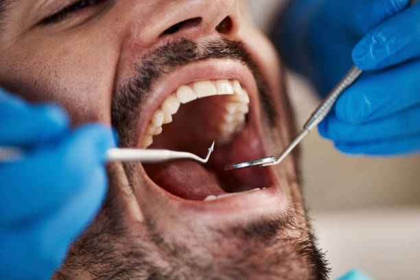 Best Emergency Wisdom Teeth Removal in Zephyrhills North, FL
